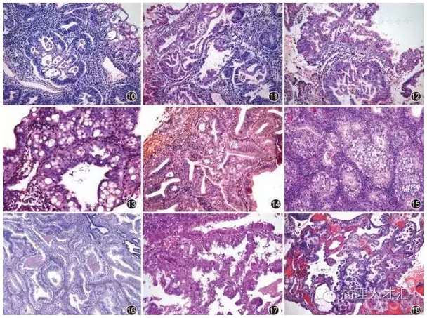 细胞取代;图12 示嗜酸性细胞腺体和乳头形成;图13 示腺上皮内微囊形成